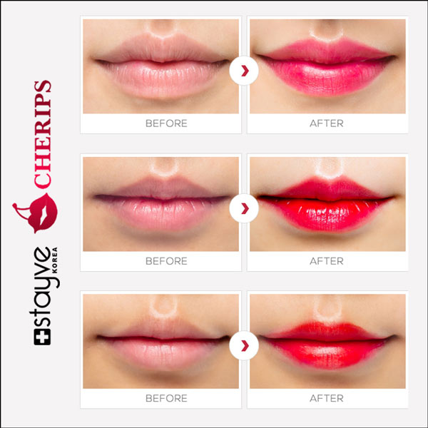 Stayve Cherips Micro-needling Ampoules Set for Lips / Lip Tint - SD Cosmetics Care