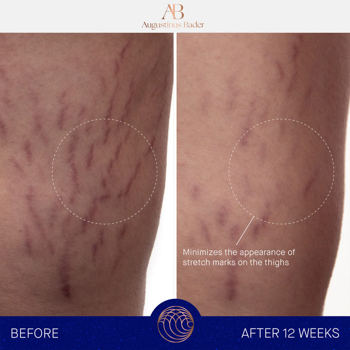 Before-and-after thigh skin showing reduced stretch marks after 12 weeks with Augustinus Bader The Body Cream