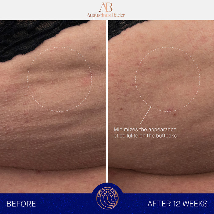 Augustinus Bader The Body Cream before-and-after showing smoother buttocks and reduced cellulite appearance