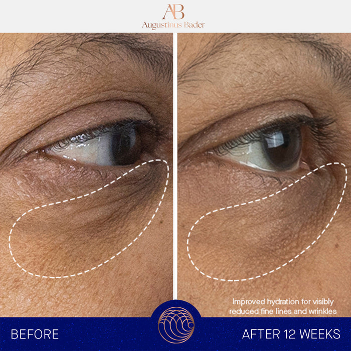 Augustinus Bader The Eye Cream before-and-after eye area showing reduced fine lines