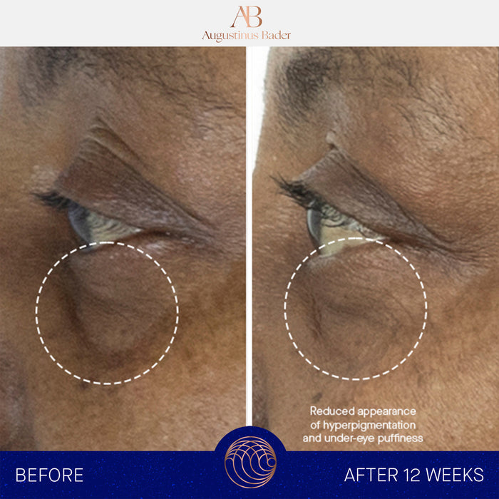 Augustinus Bader The Eye Cream before-and-after eye area showing reduced puffiness and hyperpigmentation