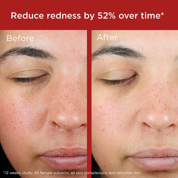 Before and after facial redness reduction with EltaMD UV Skin Recovery SPF 50