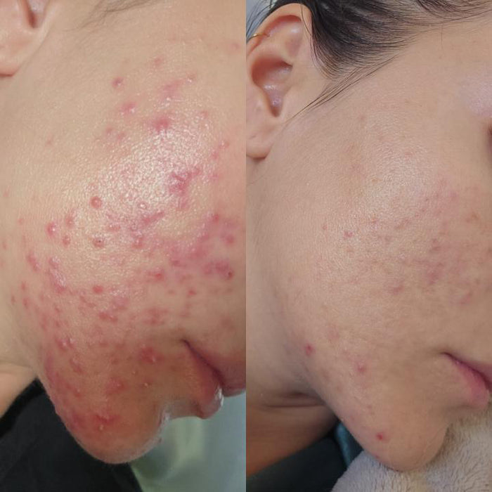 Before and after photographs of a customer's cheek, showing fewer breakouts in the second image.