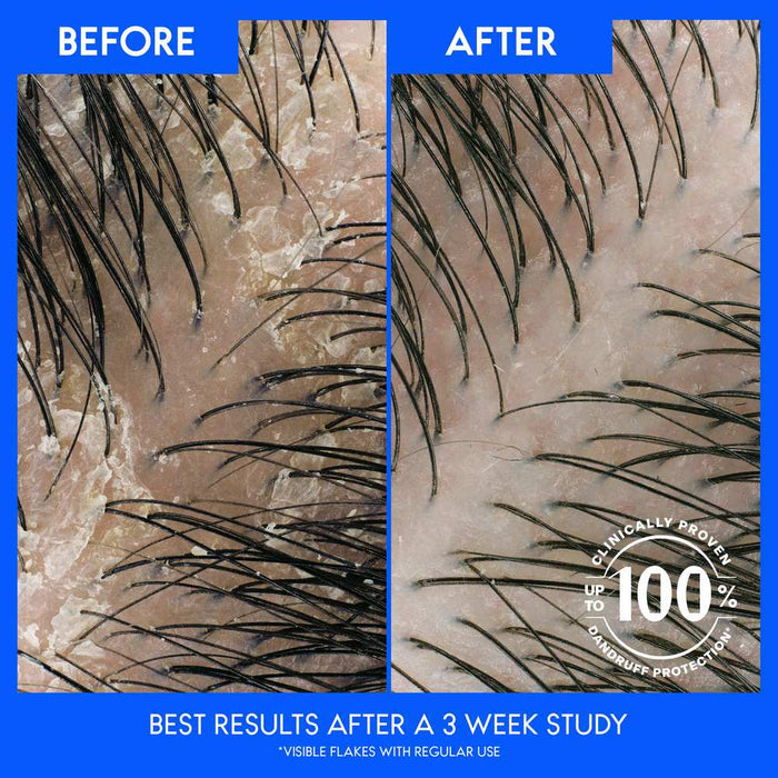 HEAD & SHOULDERS Pyritinol Zinc Dandruff Shampoo + Conditioner Classic Clean  شامبو وبلسم هيد اند شولدرز بايريثيون الزنك كلاسيك كلين ضد القشرة
