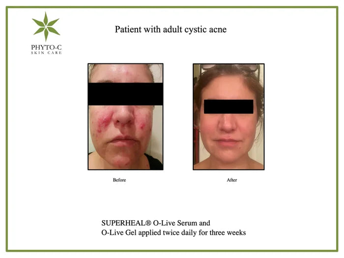 Before and after adult cystic acne results with PHYTO-C SuperHeal O-Live Serum