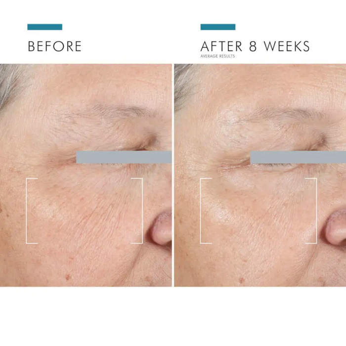 Before and after 8 weeks of under-eye treatment showing reduced crow's feet and wrinkles