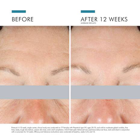 Before and after 12 weeks of SkinCeuticals A.G.E. Interrupter Advanced showing smoother forehead wrinkles