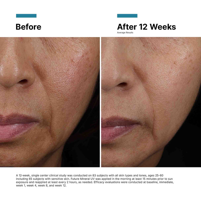 Before and after 12-week facial skin results with fewer dark spots and improved texture