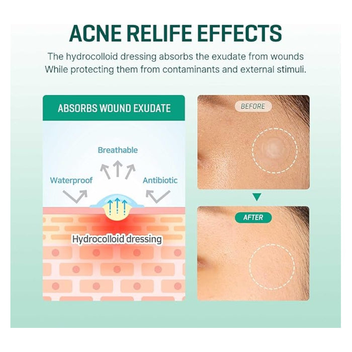 SOME BY ME 30 Days Miracle Clear Spot Patch | VGLE Beauty Canada
