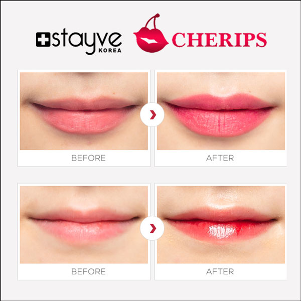 Stayve Cherips Micro-needling Ampoules Set for Lips / Lip Tint - SD Cosmetics Care