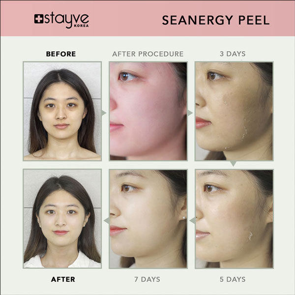 Stayve Seanergy Peel Kit – 5 Ampoules & 5 Solutions for Powerful Skin Renewal - SD Cosmetics Care